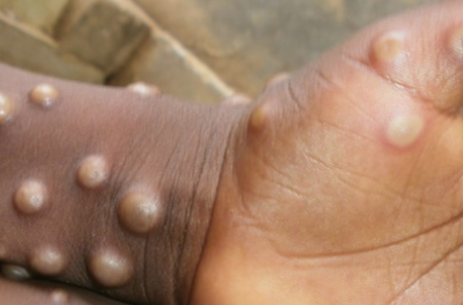 monkeypox