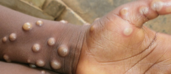 monkeypox
